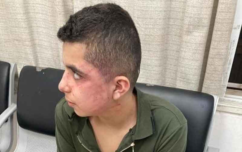 تعرض الطفل محمد حاج يحيى (14 عاماً) للضرب المبرح على يد عناصر شرطة الاحتلال الاسرائيلي