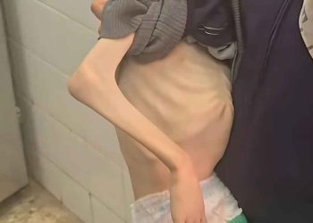 ارتفاع وفيات التجويع في غزة إلى 193 بينهم 96 طفلاً