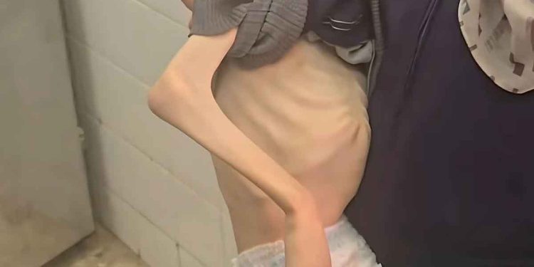 ارتفاع وفيات التجويع في غزة إلى 193 بينهم 96 طفلاً