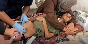 بسبب التجويع والحصار.. 3 وفيات جديدة بمتلازمة “غيلان باريه” في غزة