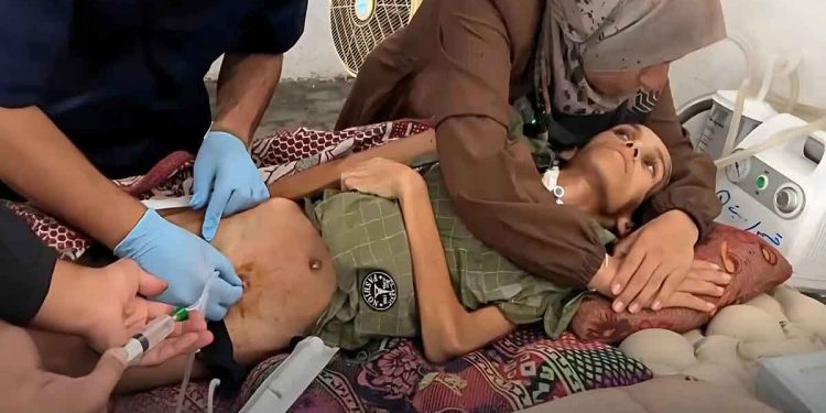 بسبب التجويع والحصار.. 3 وفيات جديدة بمتلازمة “غيلان باريه” في غزة