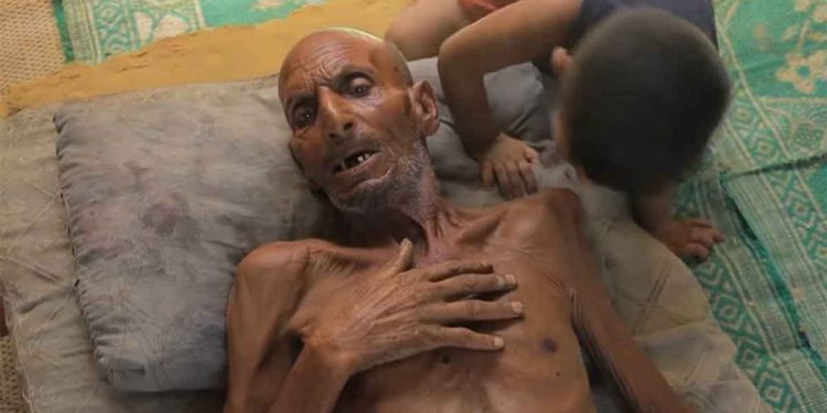 تفشٍّ نادر وفتاك.. “غيلان باريه” ينهش أطفال غزة وسط التجويع والدمار