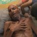تفشٍّ نادر وفتاك.. “غيلان باريه” ينهش أطفال غزة وسط التجويع والدمار